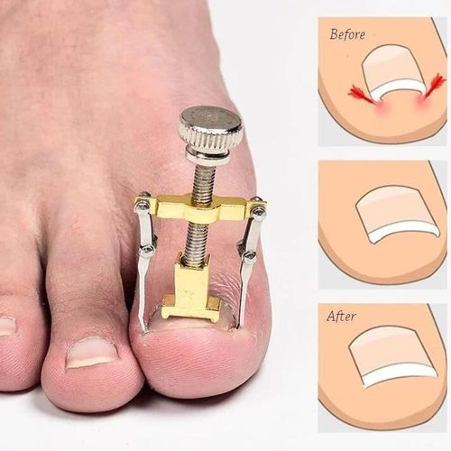 Toes correction tool