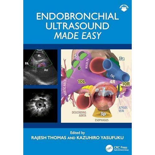 Endobronchial Ultrasound Made Easy: Made Easy ,Ed. :1