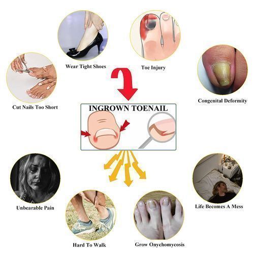 product_image_name-Generic-أداة تصحيح أظافر القدمين الغائرة تحت الجلد-8