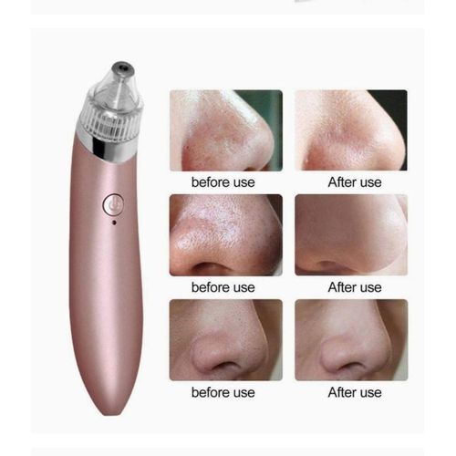 product_image_name-Generic-جهاز إزالة الرؤوس السوداء وتنظيف البشرة-2