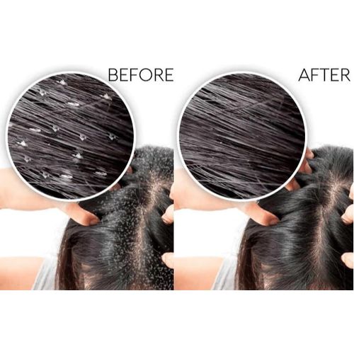 product_image_name-Hebatt Pharma-شامبو SANUS HAIR المضاد للقشرة 300 مل-2